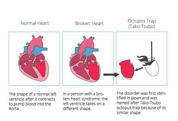 Early Indications of Heart Broken Syndrome