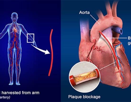 Coronary Artery Bypass Graft (CABG)